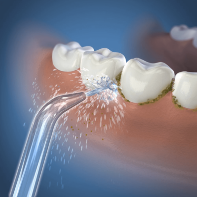 Elektriline hambavahede puhastaja on hambavahede hoolduseks mõeldud seade, mille abil saavutada tervikliku suuhügieeni.