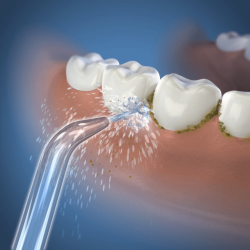 Elektriline hambavahede puhastaja on hambavahede hoolduseks mõeldud seade, mille abil saavutada tervikliku suuhügieeni.